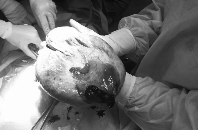 В перинатальном центре прооперировали девочку с кистой, в которой было три литра жидкости В перинатальном центре прооперировали девочку с кистой, в которой было три литра жидкости