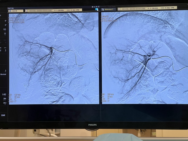 В областном онкоцентре внедрили новый метод лечения опухолей печени