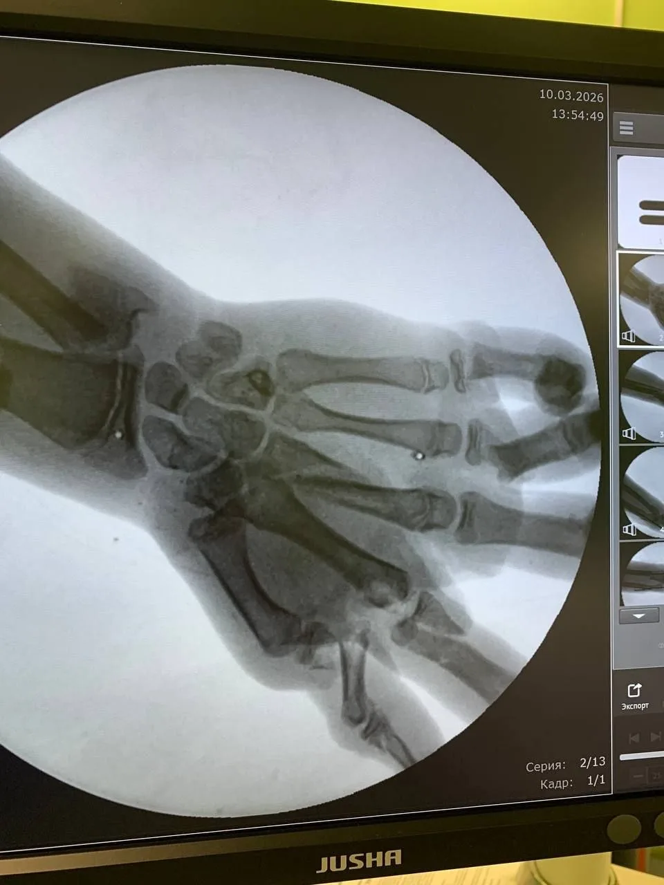 В Калининграде врачи Детской областной больницы спасли кисть подростка после взрыва снаряда